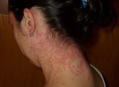 Euproctis Chrysorrhoea skin rash cutted by Euproctis_Chrysorrhoea_skin_rash.jpg: Cyware
derivative work: B kimmel (talk). Used under a Public domain license.