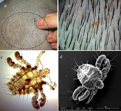 Pediculus humanus capitis 2 by Ran Yuping et al.. Used under a CC BY-SA 3.0 license.